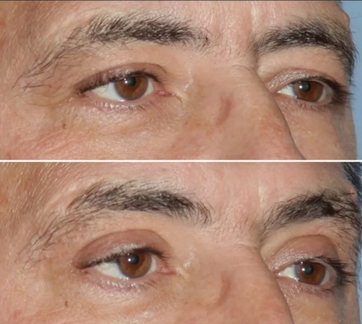 Доктор Мясников пластика век