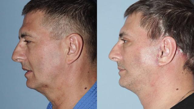 Доктор Мясников подтяжка лица