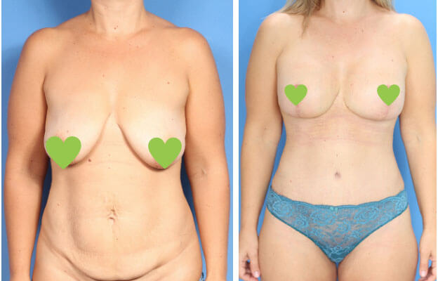 Фото до после коррекции груди