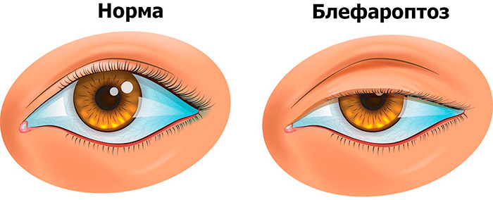 Блефароптоз&nbsp;&mdash; неудачная блефаропластика и&nbsp;ее последствия