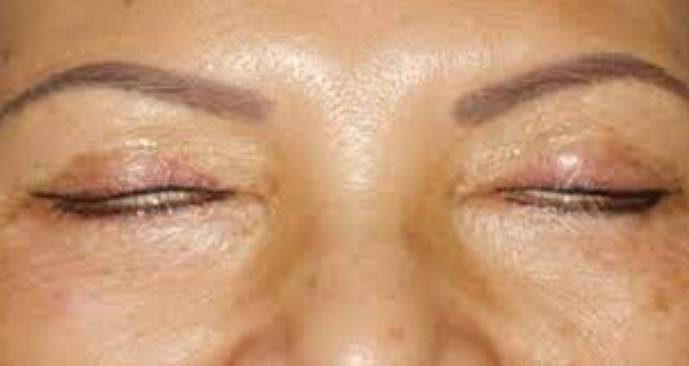 Фото неудачной блефаропластики&nbsp;&mdash; лагофтальма