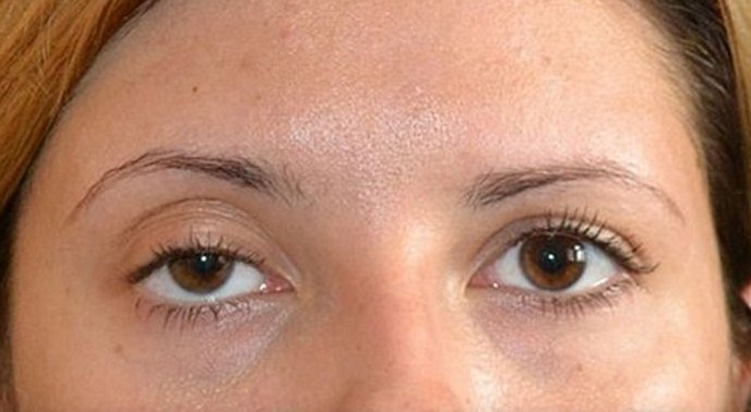 Неудачная блефаропластика фото после