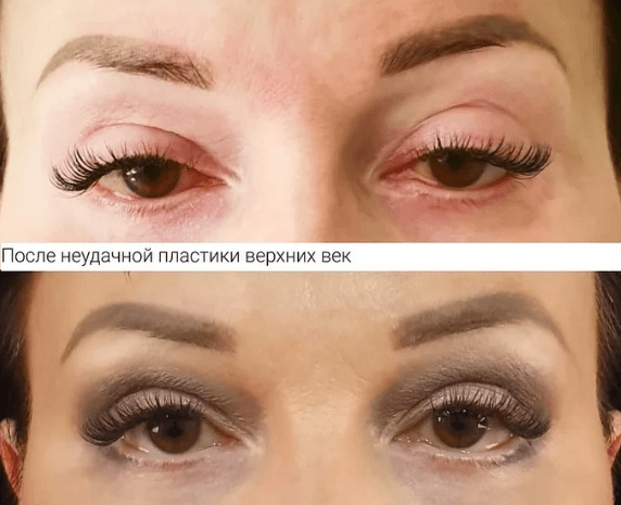 Неудачная блефаропластика: фото до&nbsp;после