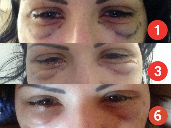 Неудачная блефаропластика&nbsp;&mdash; фото