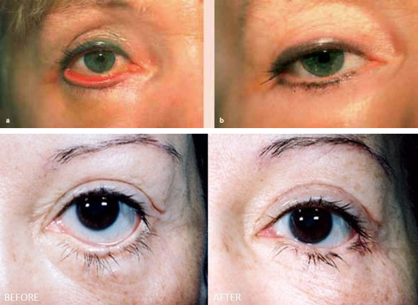 Неудачная блефаропластика: фото до&nbsp;после пластики