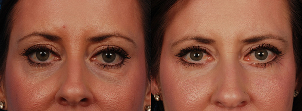 Неудачная блефаропластика&nbsp;&mdash; фото до&nbsp;после