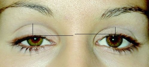 Неудачная блефаропластика&nbsp;&mdash; фото блефароптоза