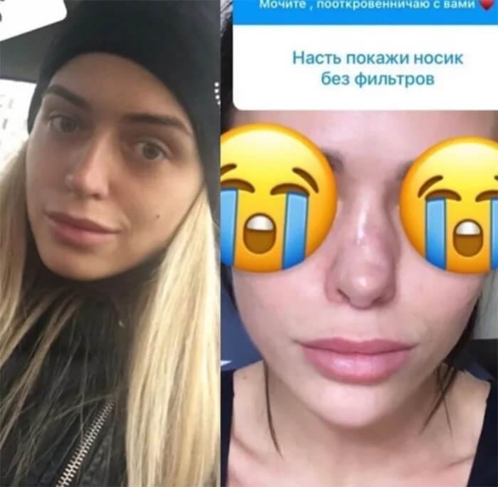 Неудачная ринопластика: фото до&nbsp;после №2