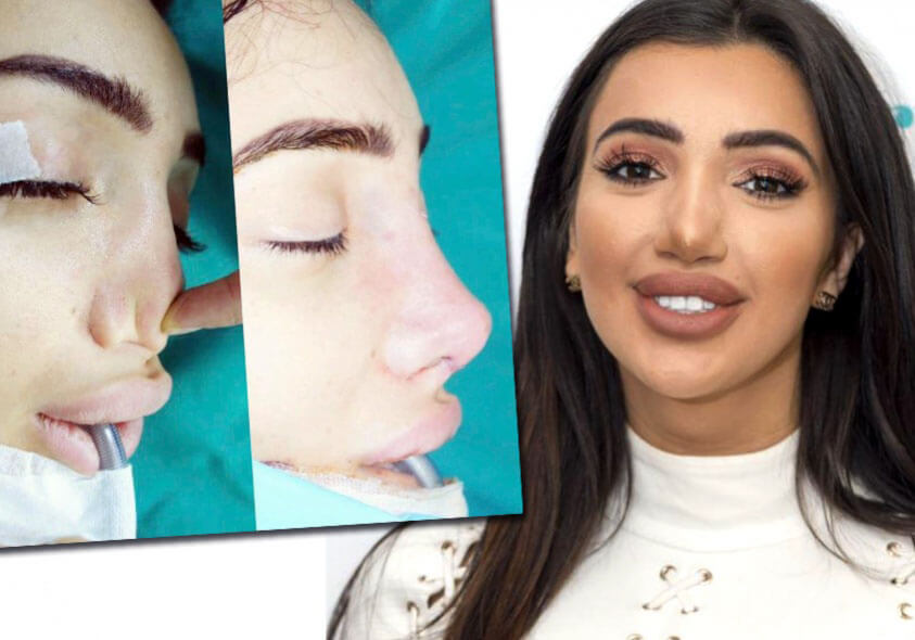 Неудачная ринопластика: фото до&nbsp;и&nbsp;после&nbsp;операции