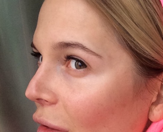 Фото неудачной ринопластики