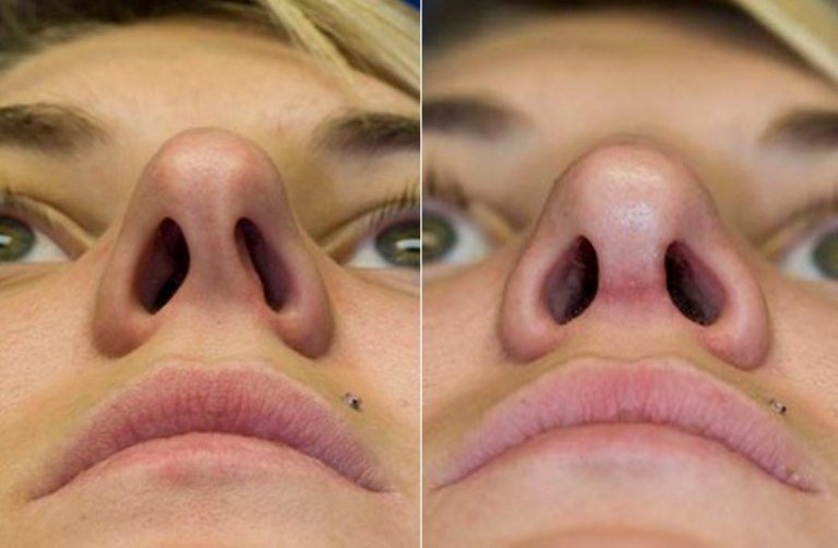 Фото неудачной ринопластики