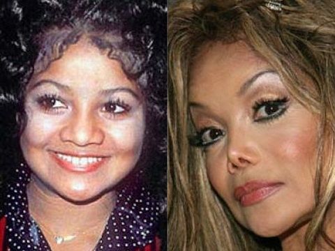 Неудачная ринопластика фото до после