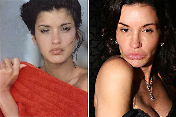 Фото до после неудачной пластики носа