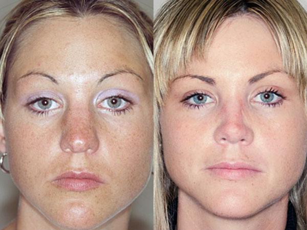 Фото до после неудачной ринопластики звезд