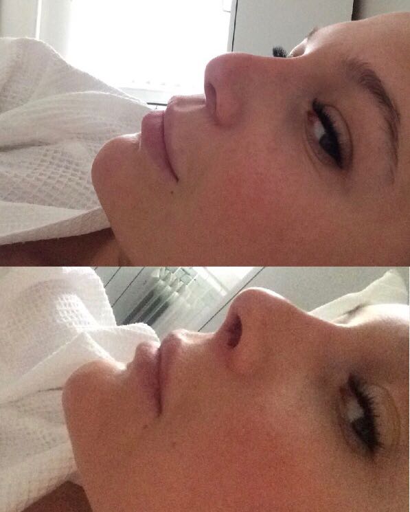 Коррекционная ринопластика