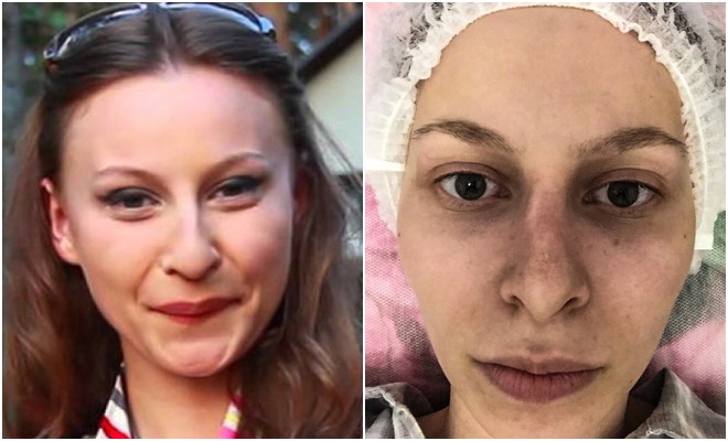 Фото до после неудачной ринопластики