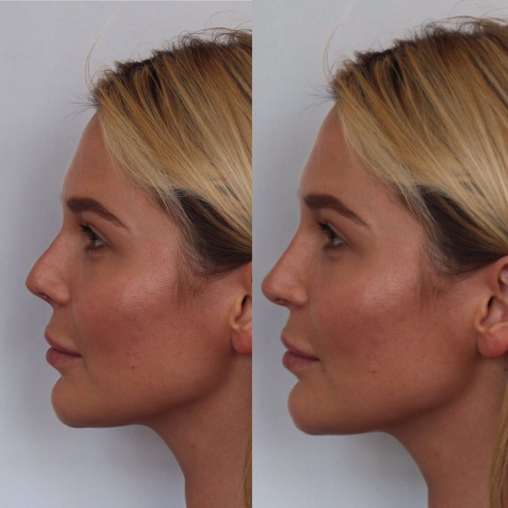 Неудачная ринопластика: фото до после повторной коррекции носа