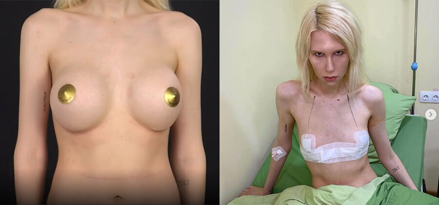 Ника Крауш до&nbsp;и&nbsp;после пластики