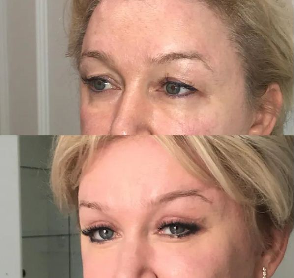 Фото до&nbsp;после подтяжки лица манекенщицы