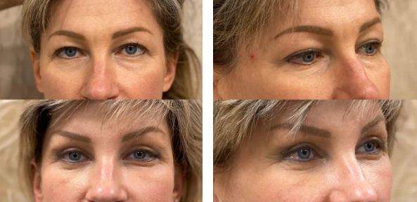 Фото до&nbsp;после подтяжки лица