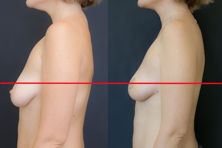 Эффект подтяжки груди фото до после (косметологические методы)