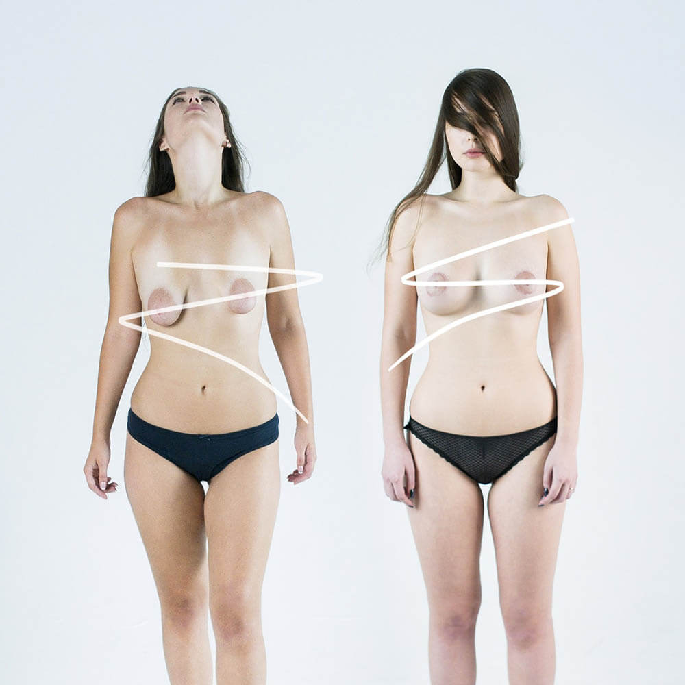 Фото до после подтяжки груди