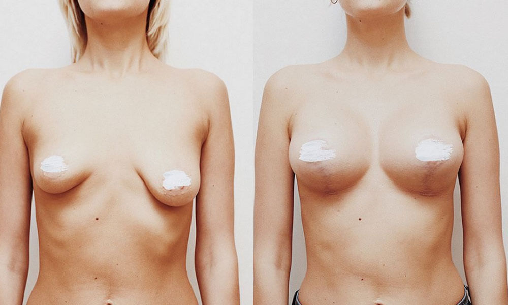 Фото до после увеличения груди с подтяжкой