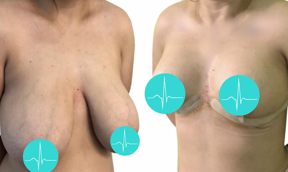 Фото до и после подтяжки груди