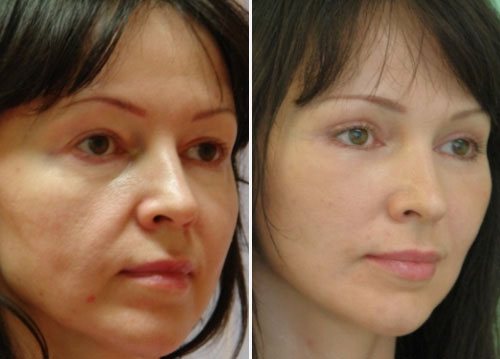 Бульдожье лицо: фото до после пластики