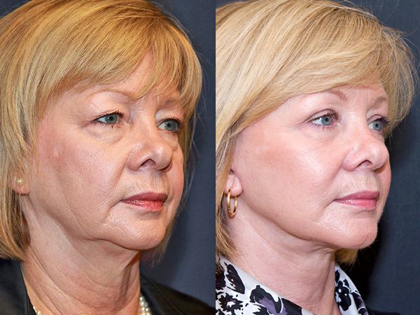 Фото до после пластики обвисших щек