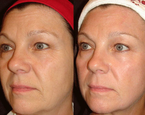 Фото до&nbsp;после фейслифтинга в&nbsp;50 лет