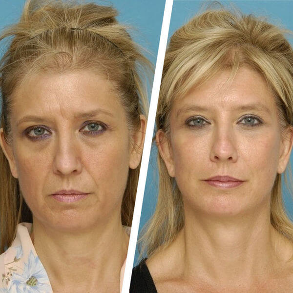 Омоложение после 50 лет фото до&nbsp;после пластики лица