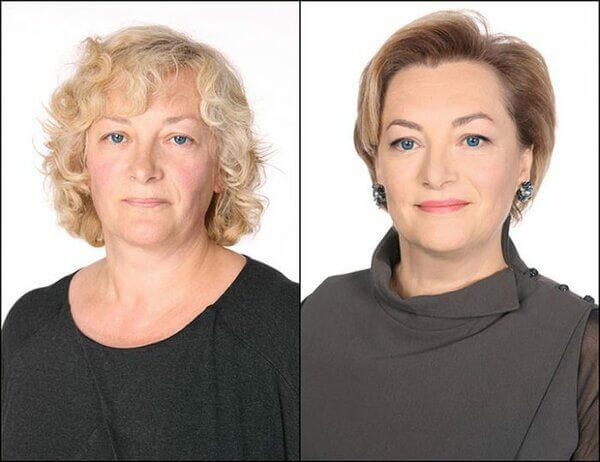 Фото до&nbsp;после подтяжки лица после 50 лет