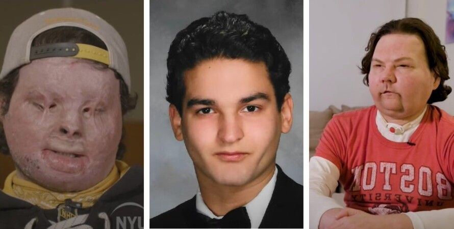 Пересадка рук и&nbsp;лица