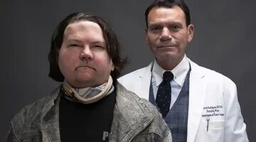 Первая пересадка рук и&nbsp;лица