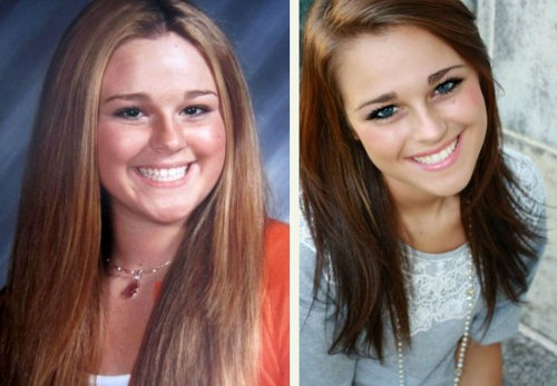 Подтяжка кожи в сочетании с липосакцией лица