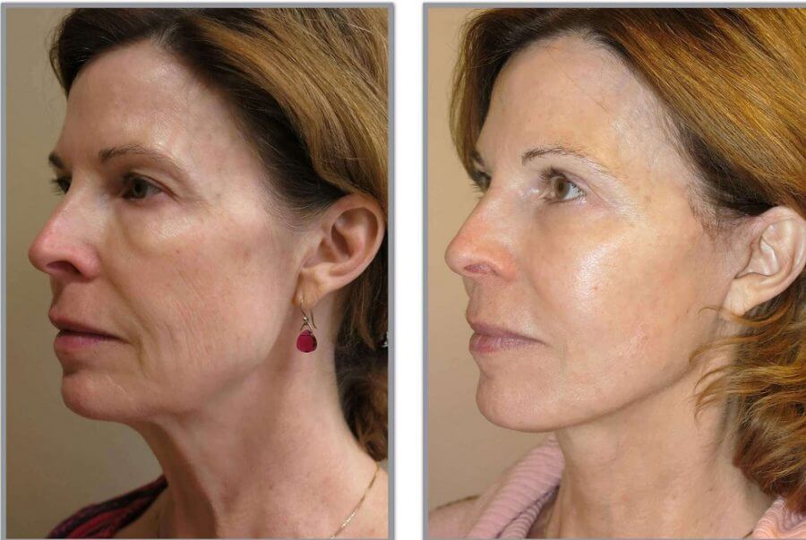 Фото до&nbsp;после подтяжки &ndash; естественный результат