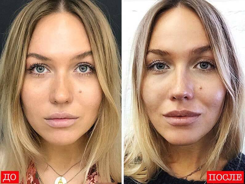 Пластика носа фото до&nbsp;после &ndash; коррекция недостатков без изменения формы