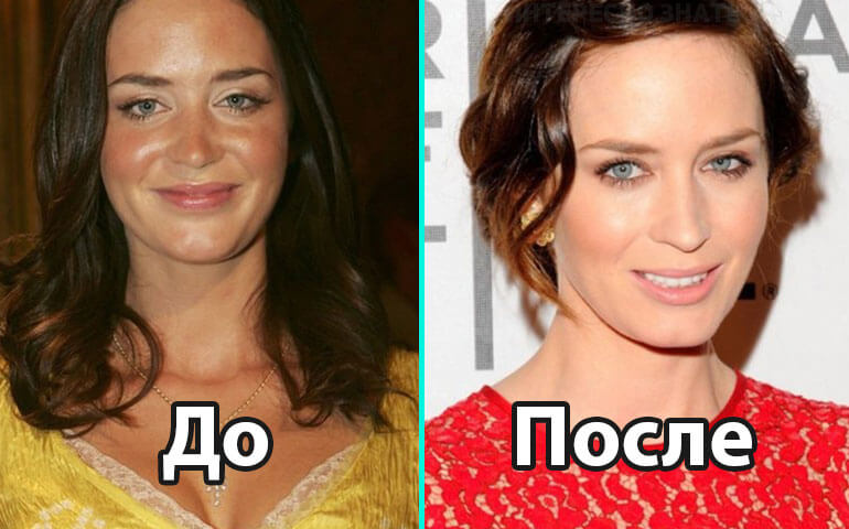 Фото до&nbsp;после пластической операции без изменения личностных черт лица