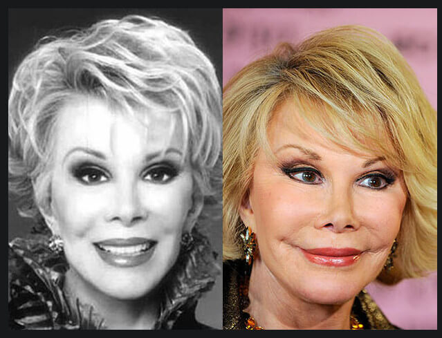 Неудачная подтяжка лица фото до&nbsp;после