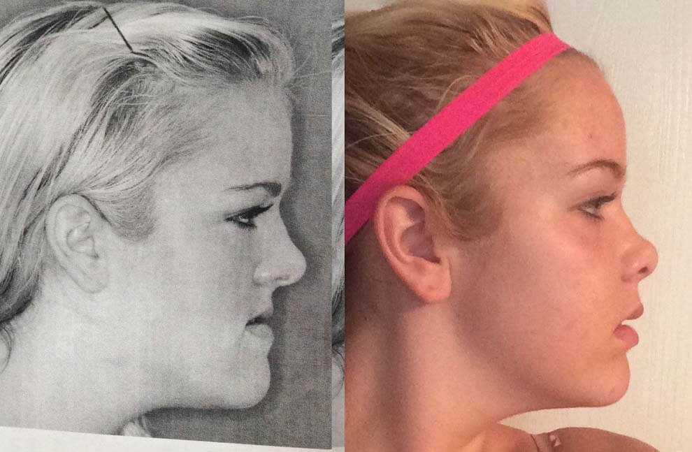 Фото до&nbsp;после краниопластики