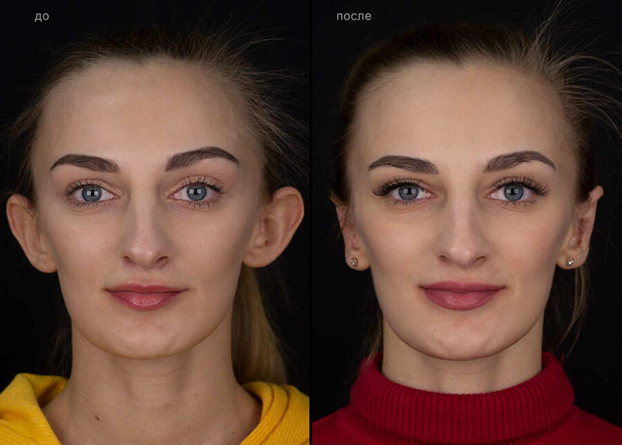 Фото до&nbsp;после отопластики