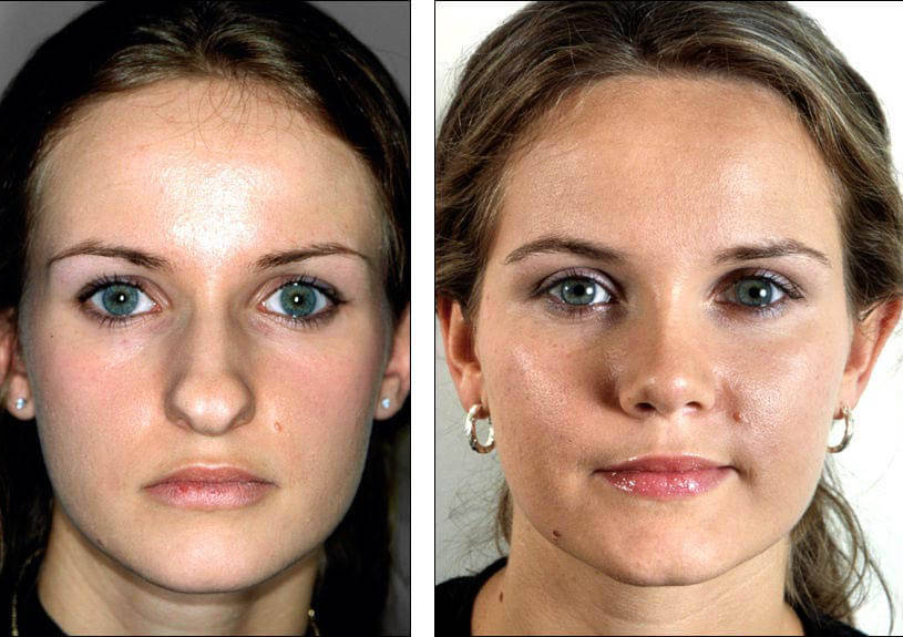 Фото до&nbsp;после ринопластики до&nbsp;25 лет