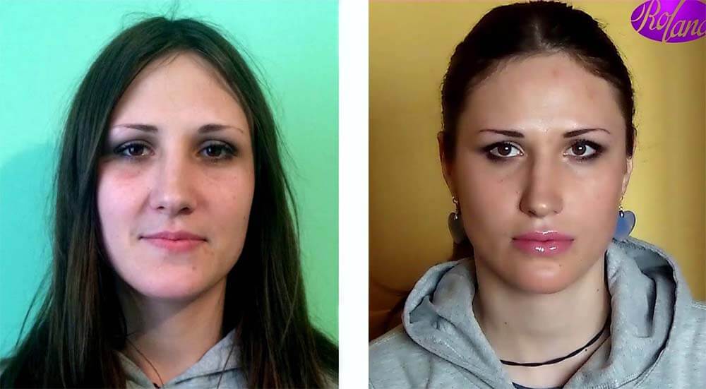 Фото до&nbsp;после пластики для&nbsp;юных пациенток