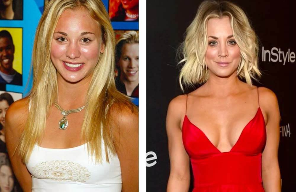 Увеличение груди фото до&nbsp;после звездной пластики