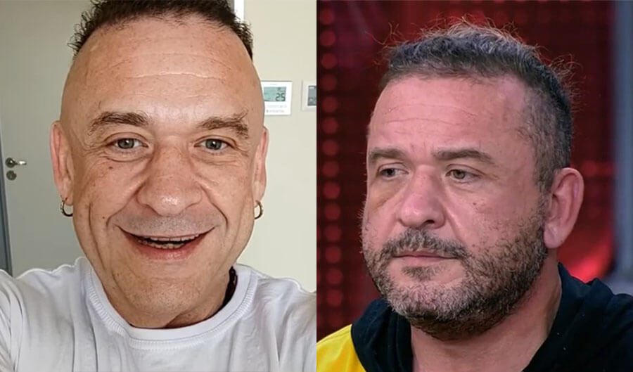 Пластика Александра Морозова до и после