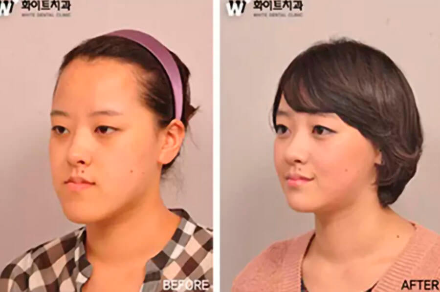 Пластика после теста у кореянки