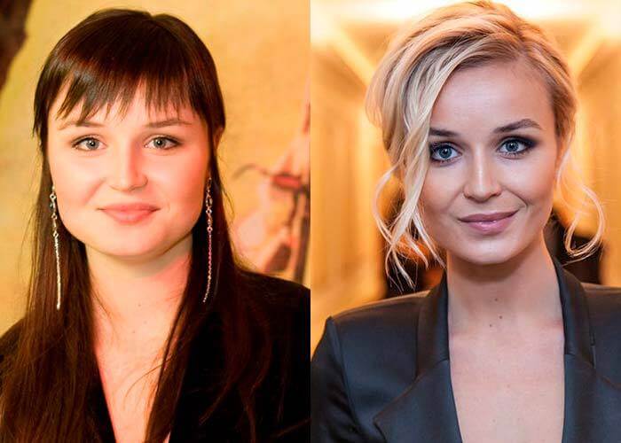 Фото до&nbsp;после пластики щек