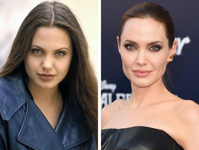 Анджелина Джоли фото до&nbsp;после удаления комков Биша