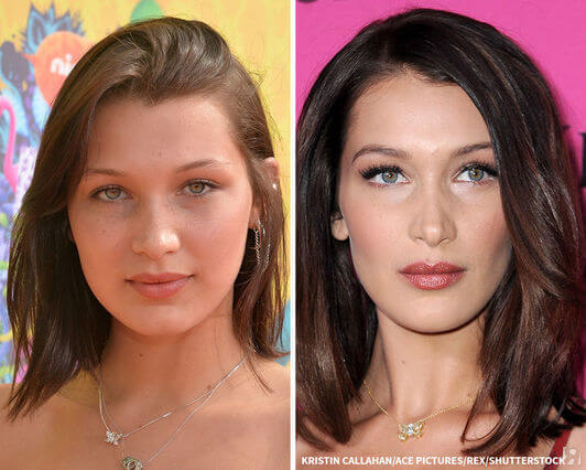 Фото до&nbsp;после пластики щек &ndash; удаление комков Биша